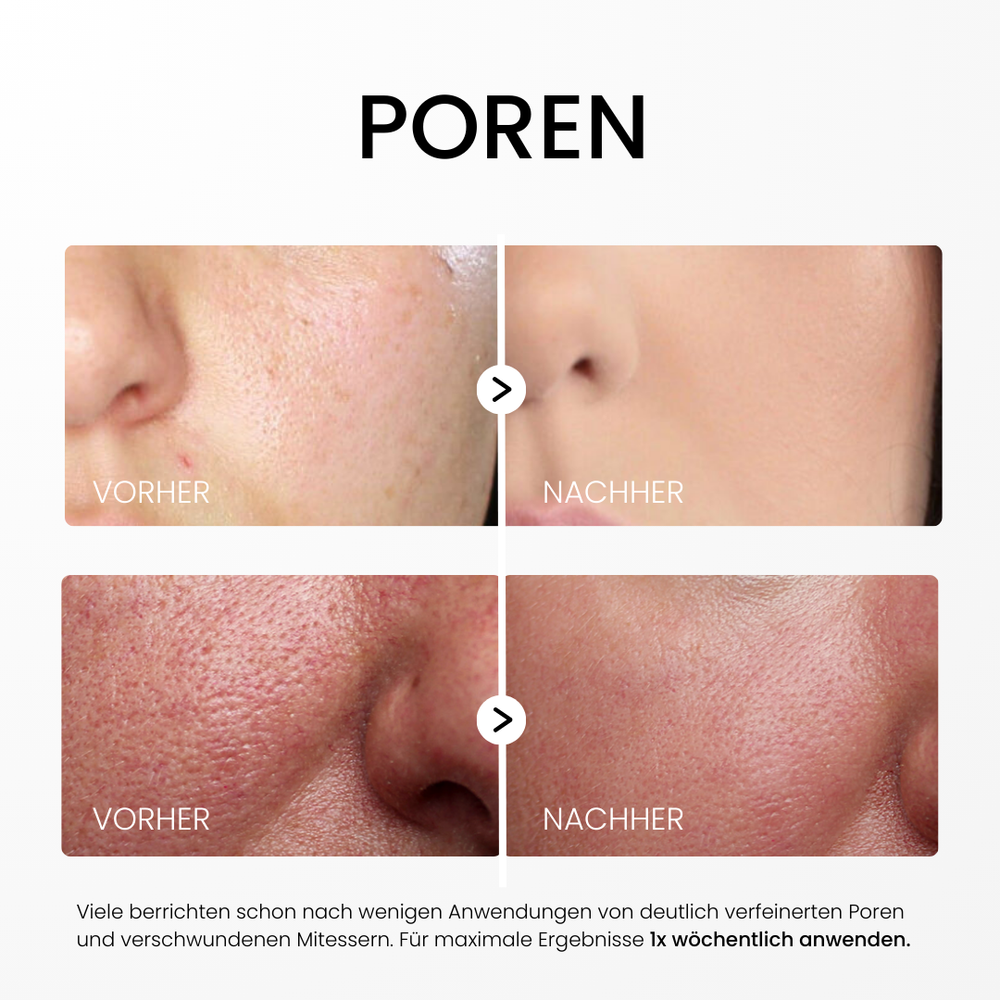 HautKlar™ - Rice Peel Glow-Serum