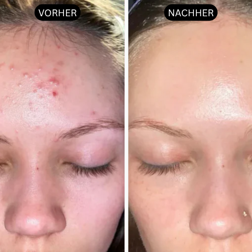 HautKlar™ - Rice Peel Glow-Serum