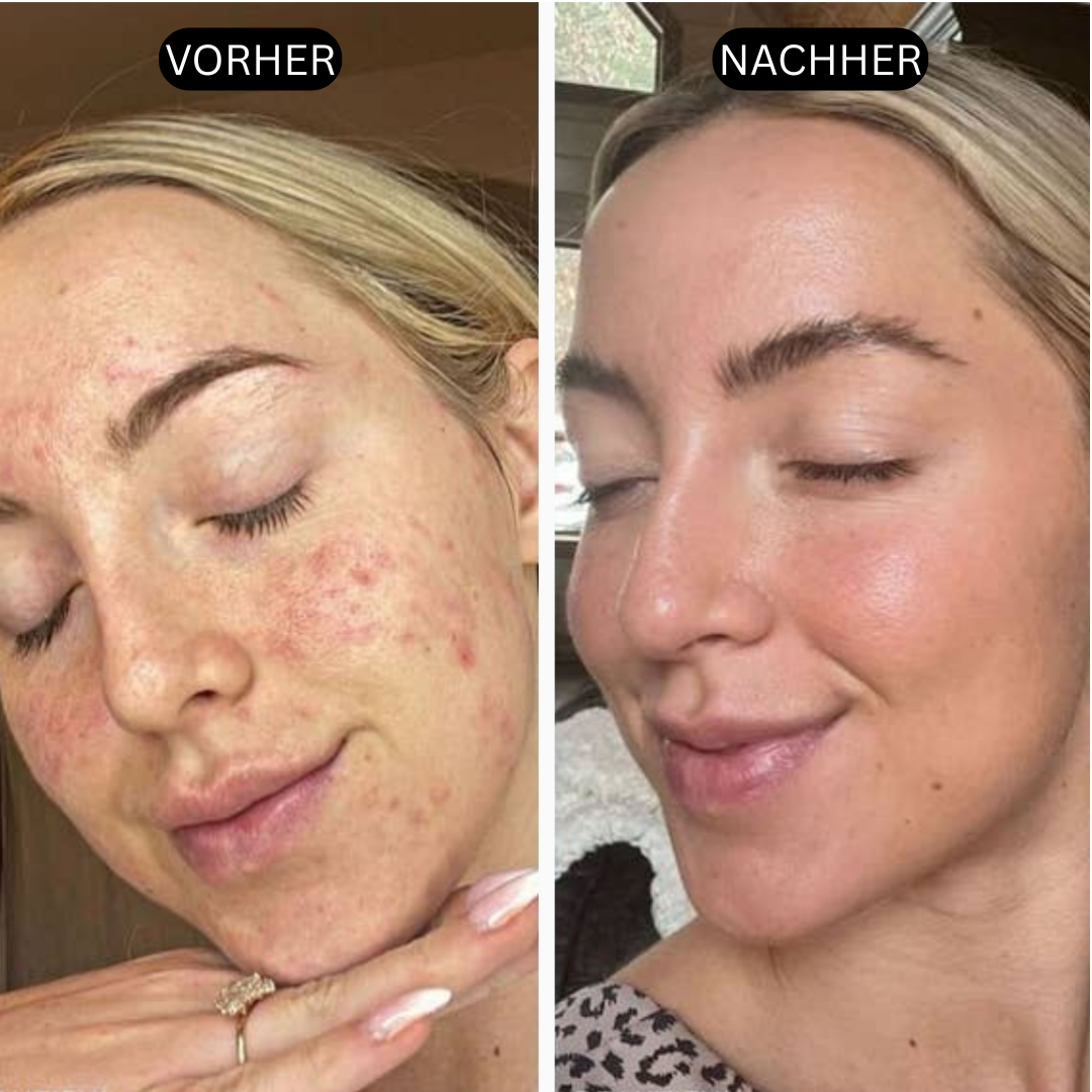 HautKlar™ - Rice Peel Glow-Serum