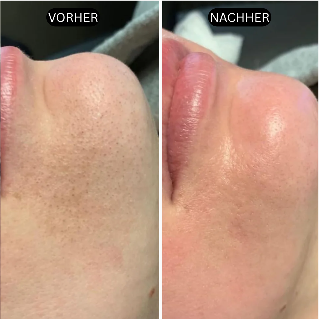 HautKlar™ - Rice Peel Glow-Serum